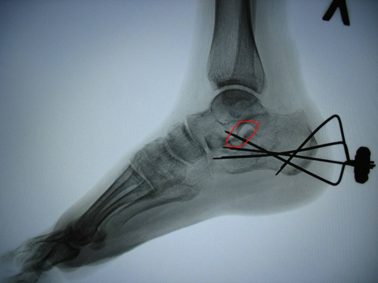 Пяточная кость после операции. Перелом пяточной кости остеосинтез. Перелом пяточной кости рентген. Осколочный перелом пяточной кости.