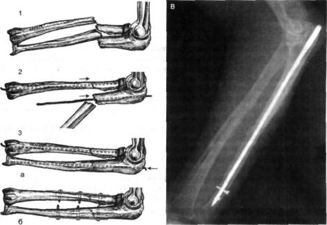 Спицы в пальце при переломе. Антеградный остеосинтез стержнем перелома локтевой кости. Интрамедуллярный остеосинтез предплечья. Интрамедуллярный остеосинтез локтевой кости.